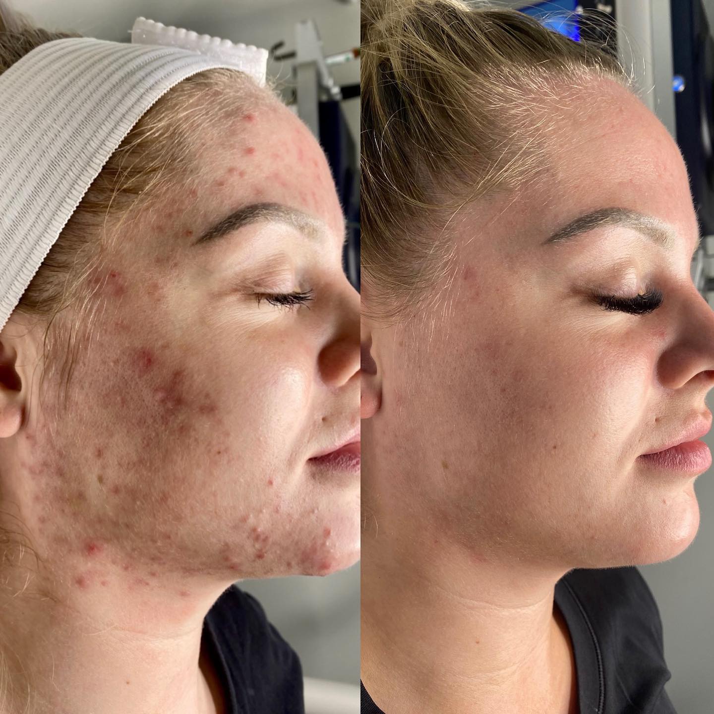 peeling cicatrice à Vénissieux Depilor