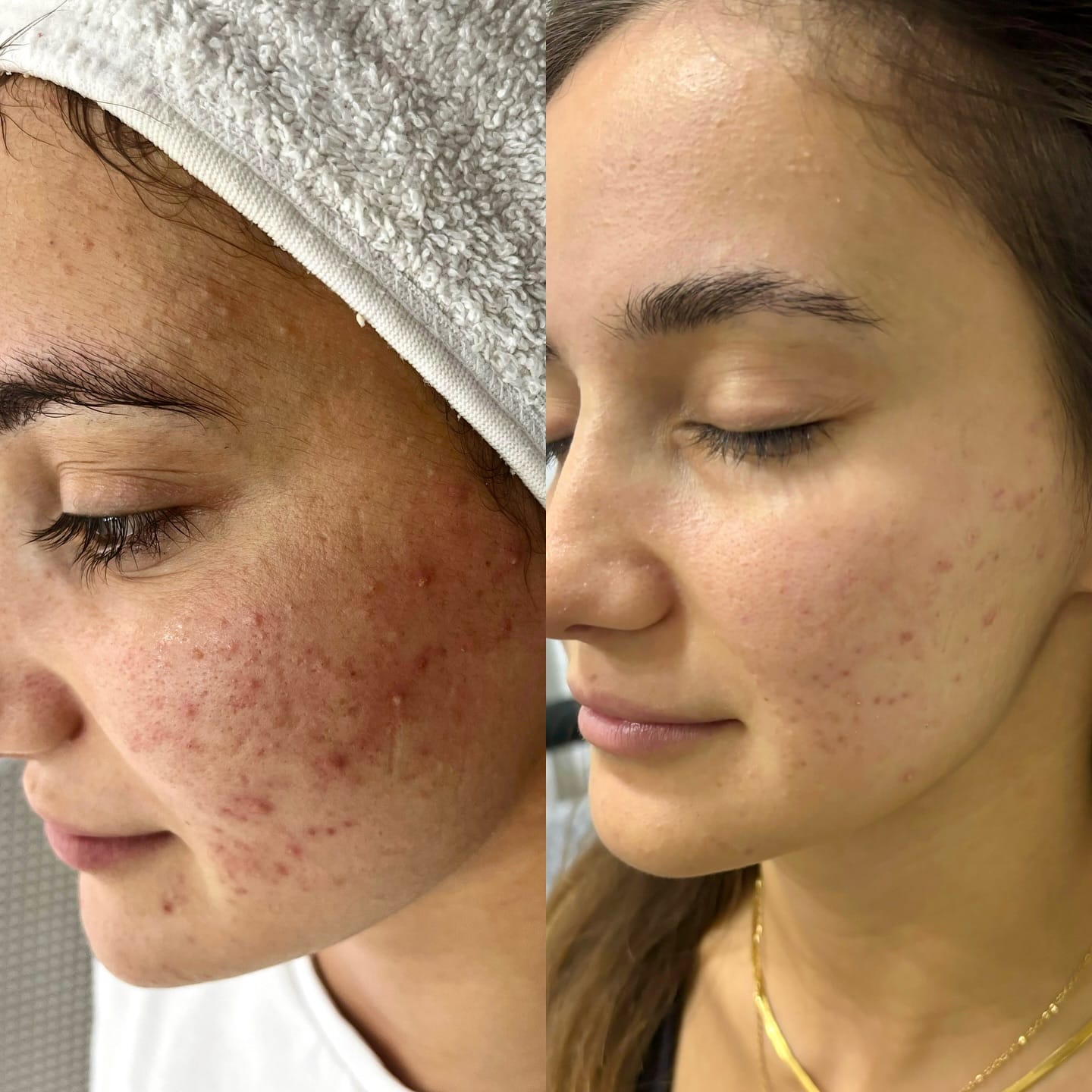 peeling visage green peel venissieux depilor