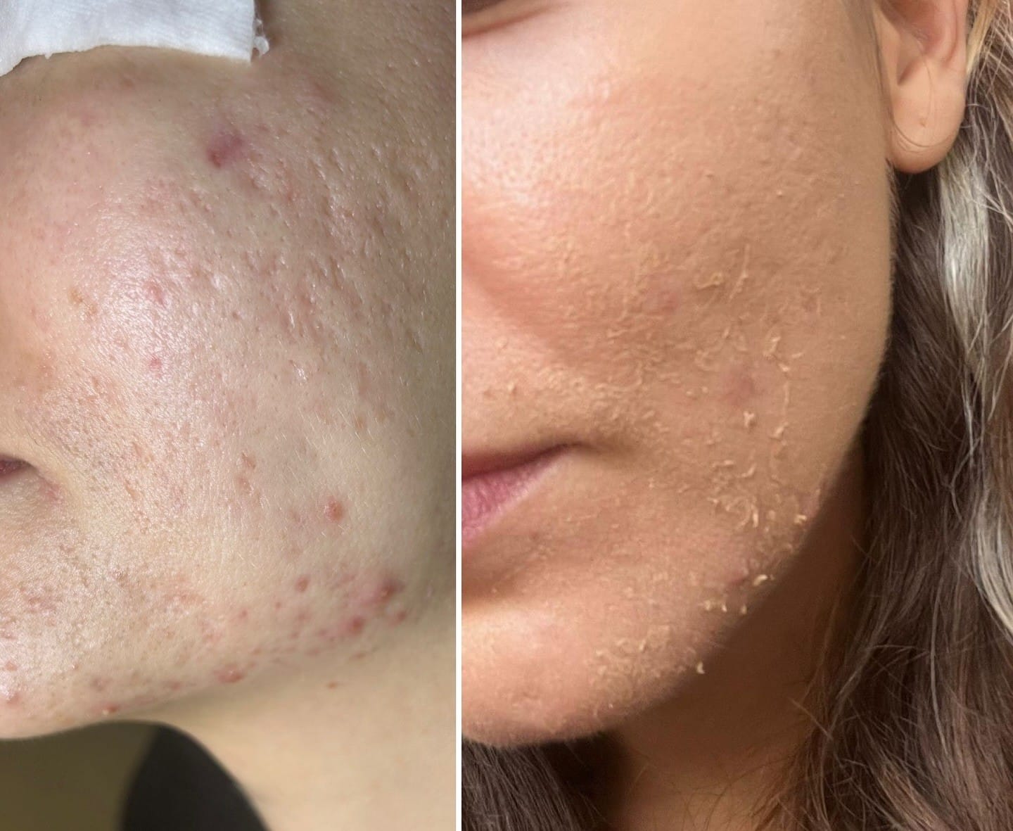 peeling du visage Vénisiseux