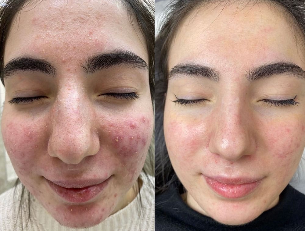 peeling Depilor Venissieux