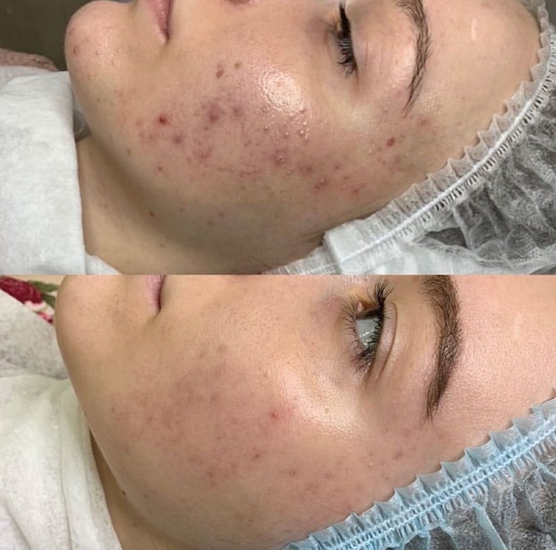 peeling visage Venissieux Depilor