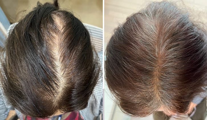 soin chute de cheveux professionnel