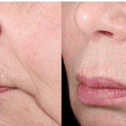 Peeling anti-âge Vénissieux