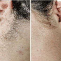 epilation electrique2