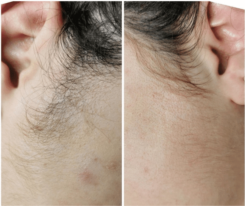 epilation electrique2