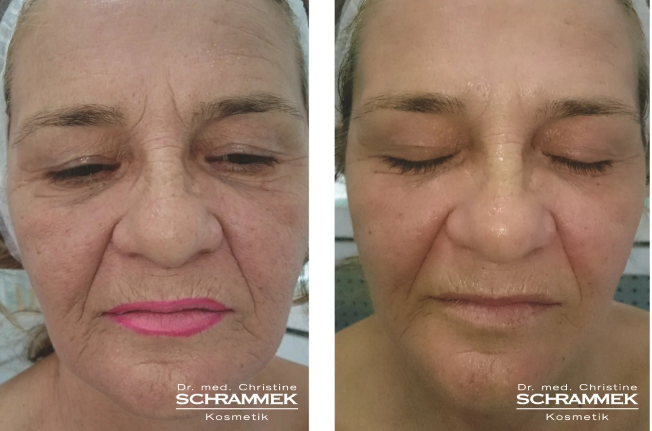 peeling anti-age venissieux Deilor