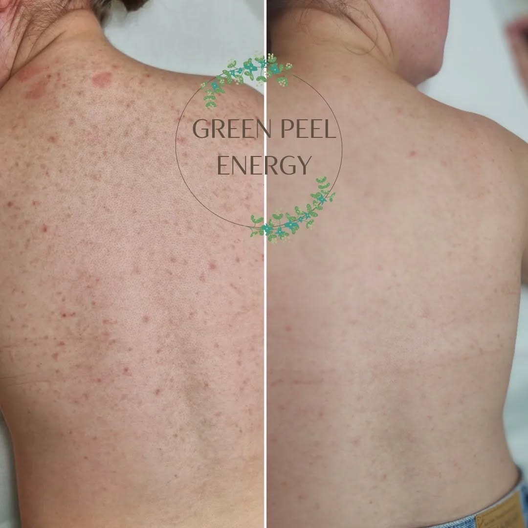 peeling corps depilor venissieux