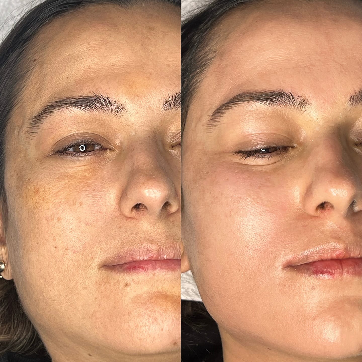 Peeling Green Peel Venissieux Depilor