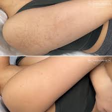 green peel venissieux depilor