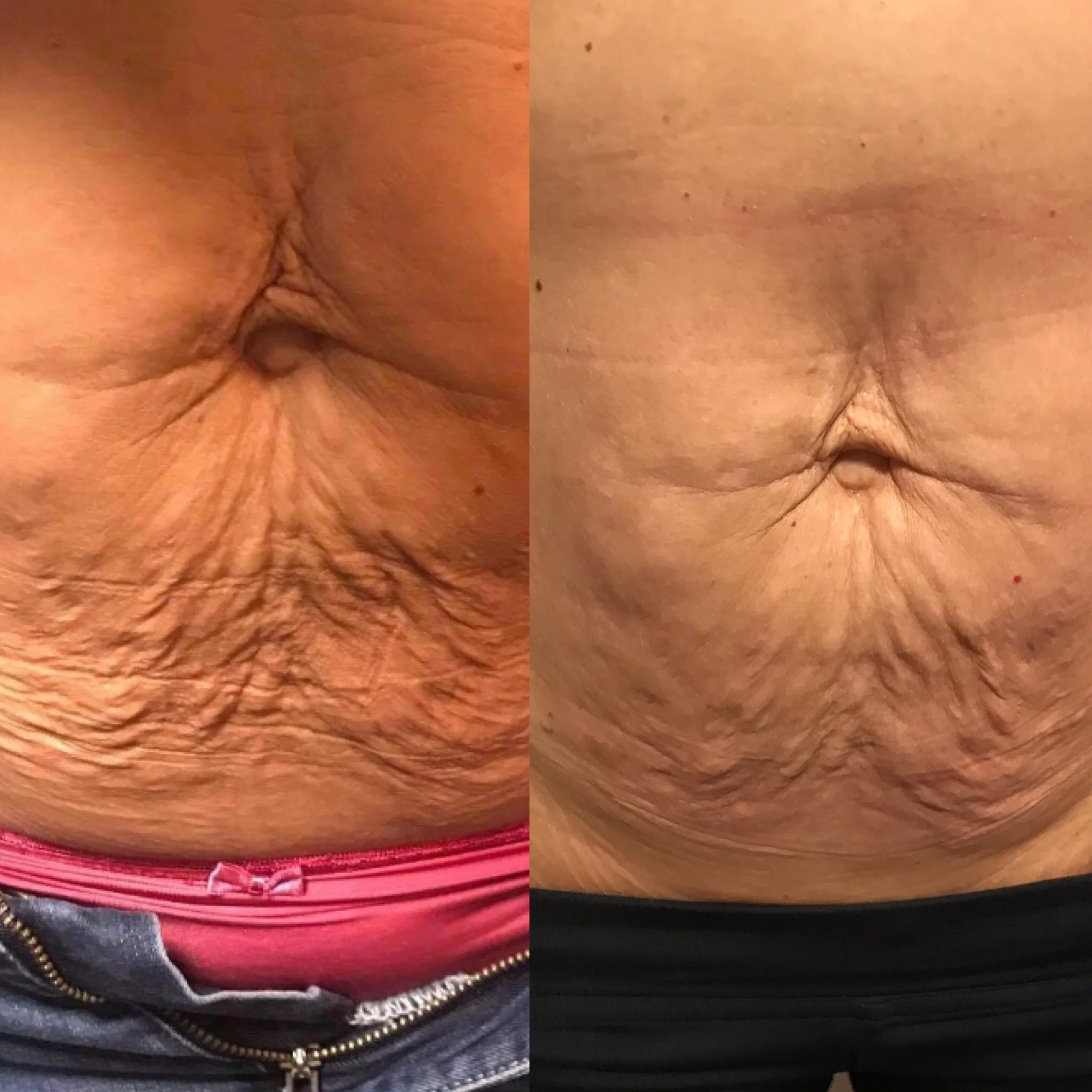 peeling cicatrice et vergeture