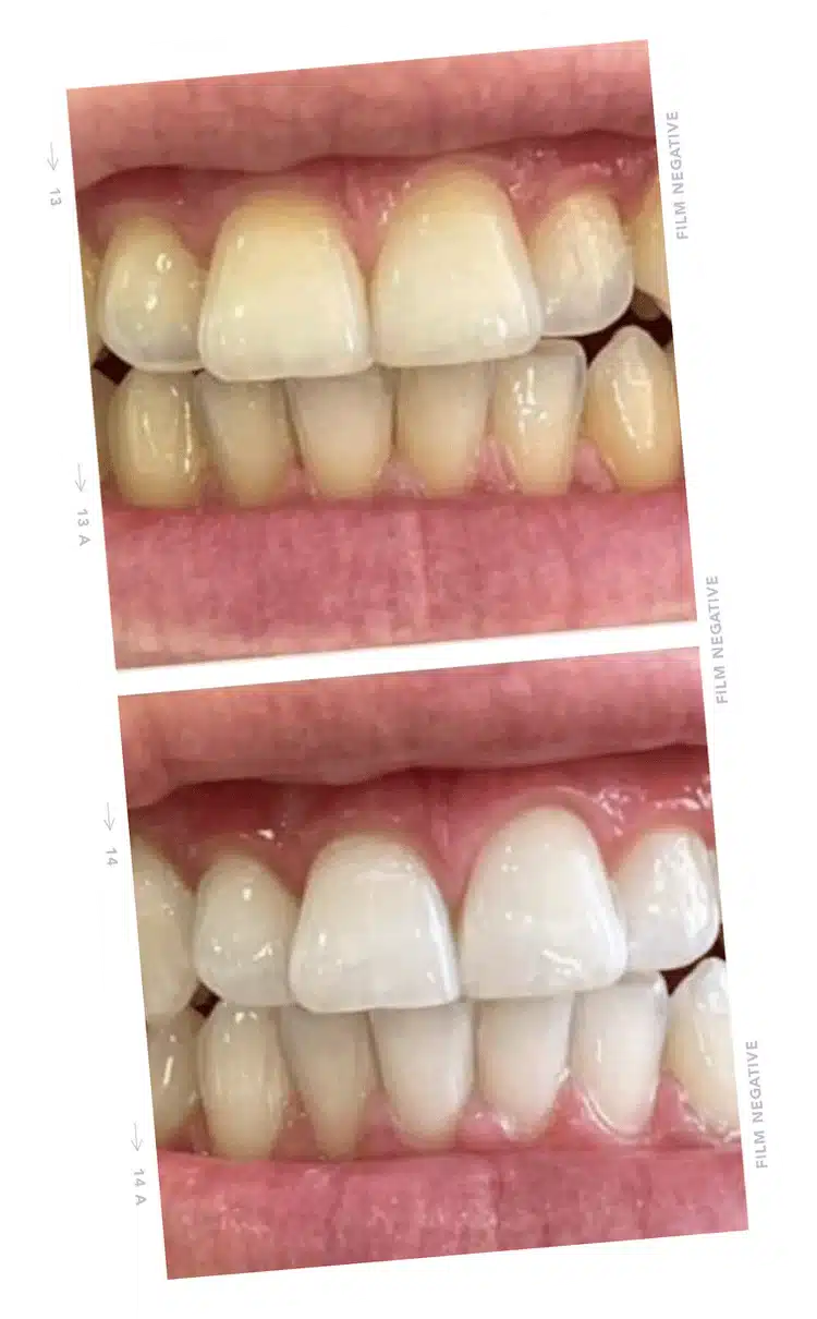 tooth1