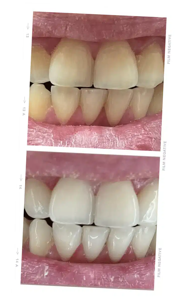 tooth2