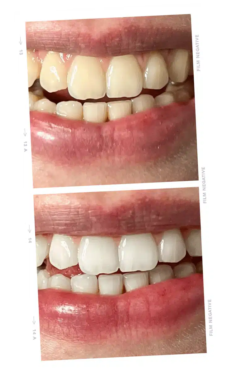 tooth3