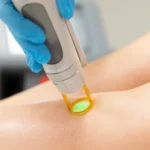 Epilation laser d'une jambe