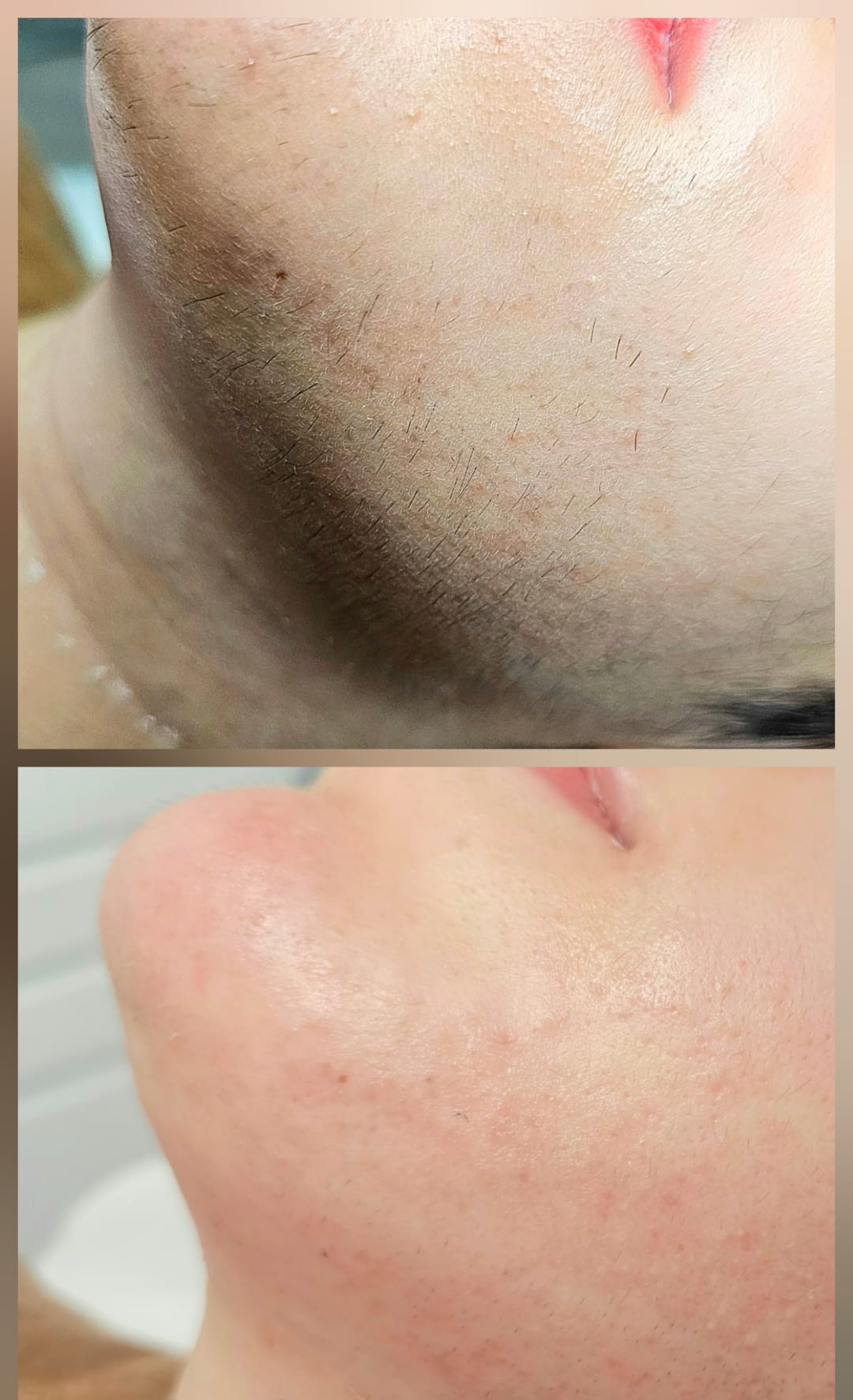 Séance électrolyse visage — Depilor