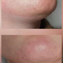 avant après électroyse depilor