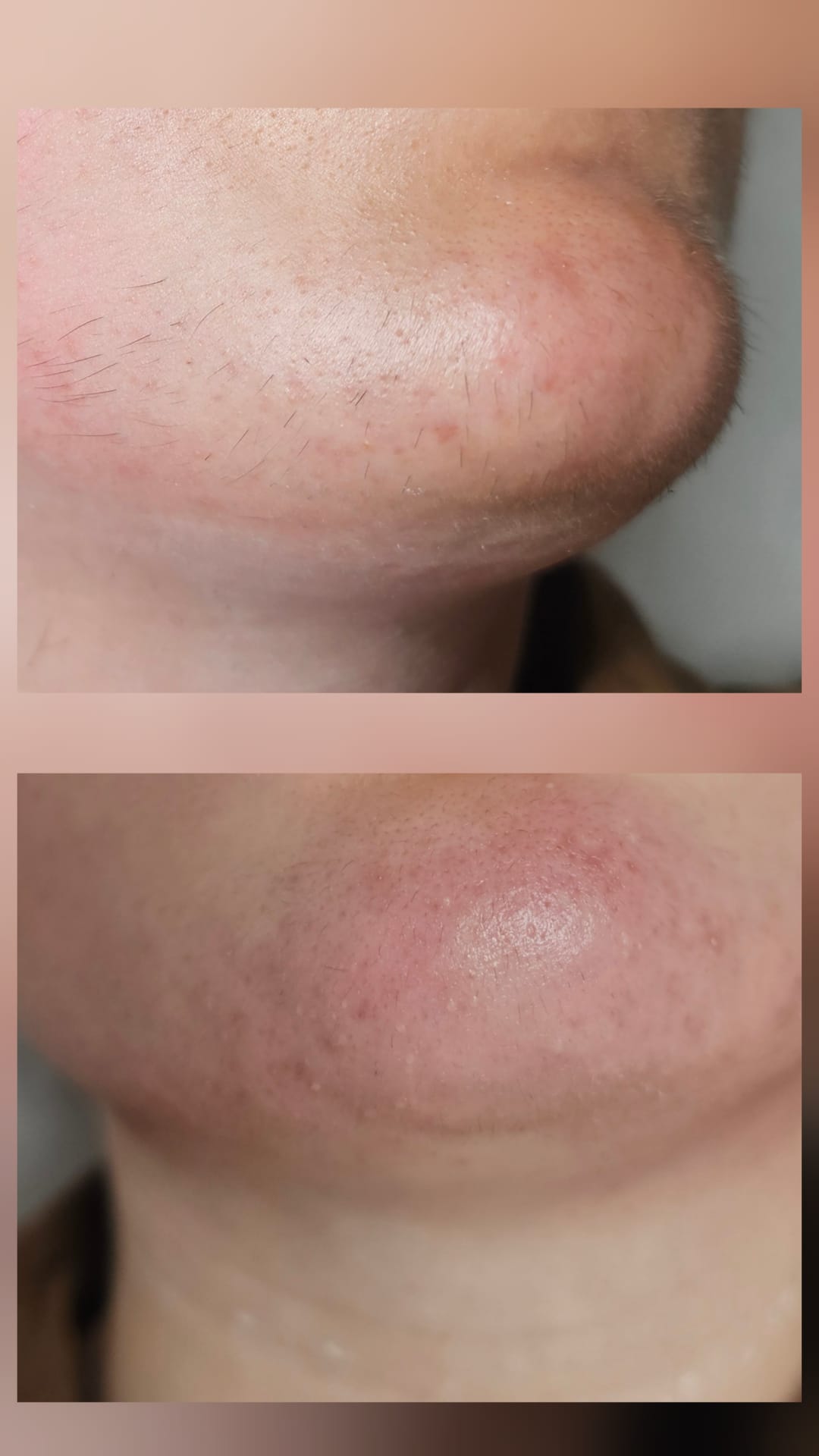 Avant après électrolyse visage Depilor résultats