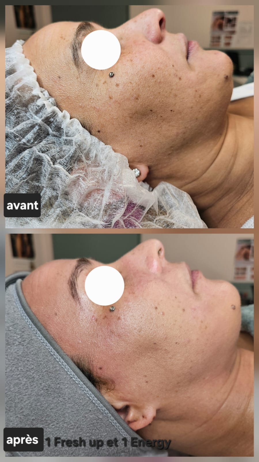 Avant protocole peeling taches pigmentaires — Institut Depilor Vénissieux