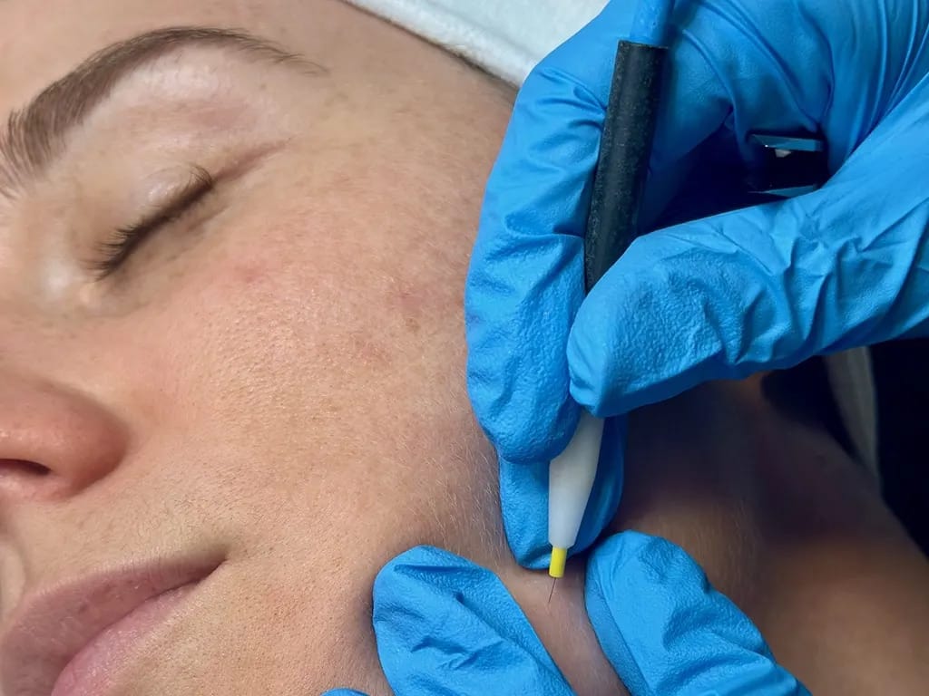 Séance épilation laser visage Depilor Vénissieux