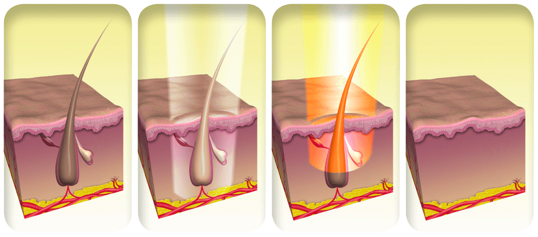Appareil d'épilation laser