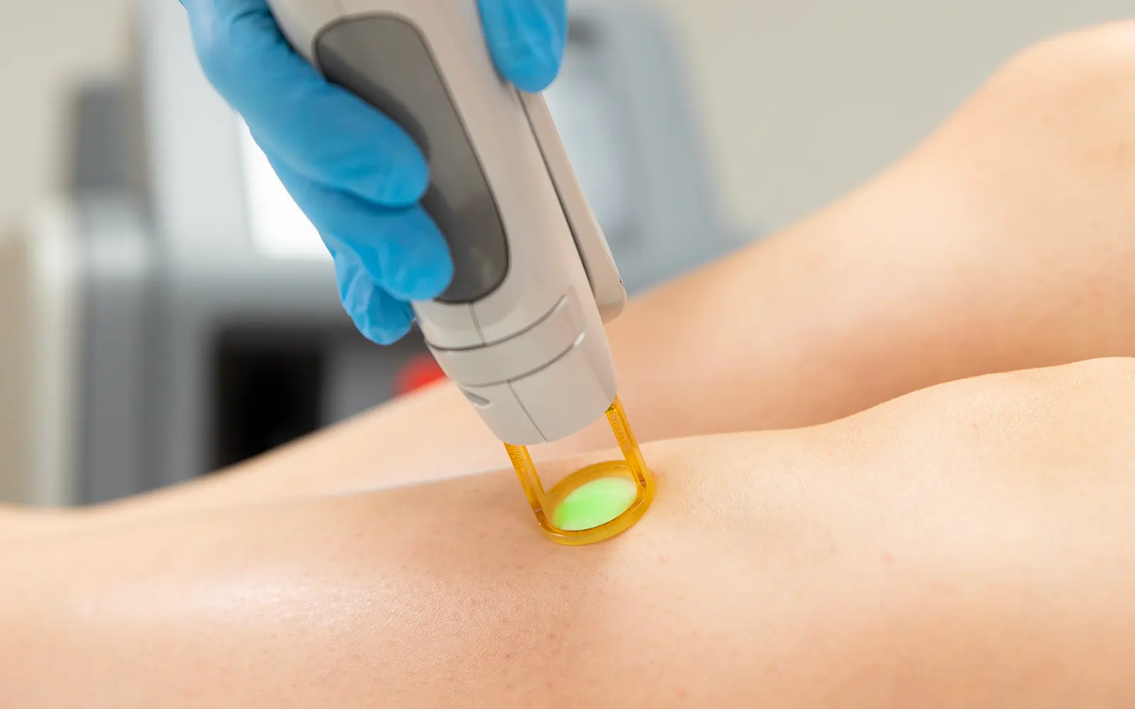 L’épilation laser est-elle vraiment définitive ? Séance sur une jambe