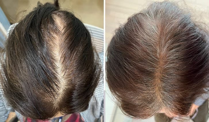Perte de cheveux liée au stress chez la femme