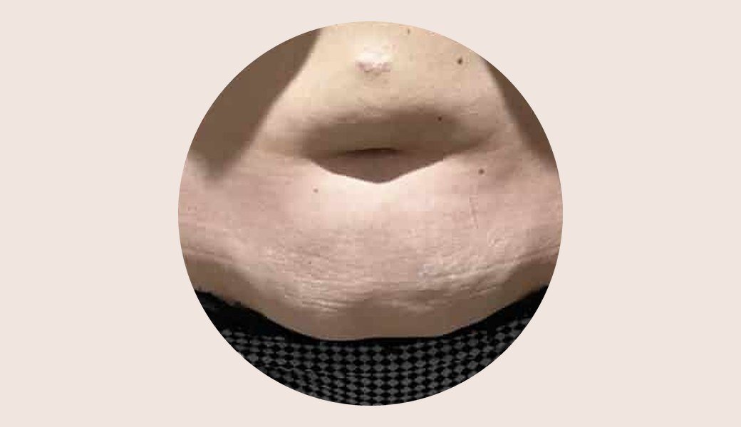 Bas-ventre avant une cure de cryolipolyse