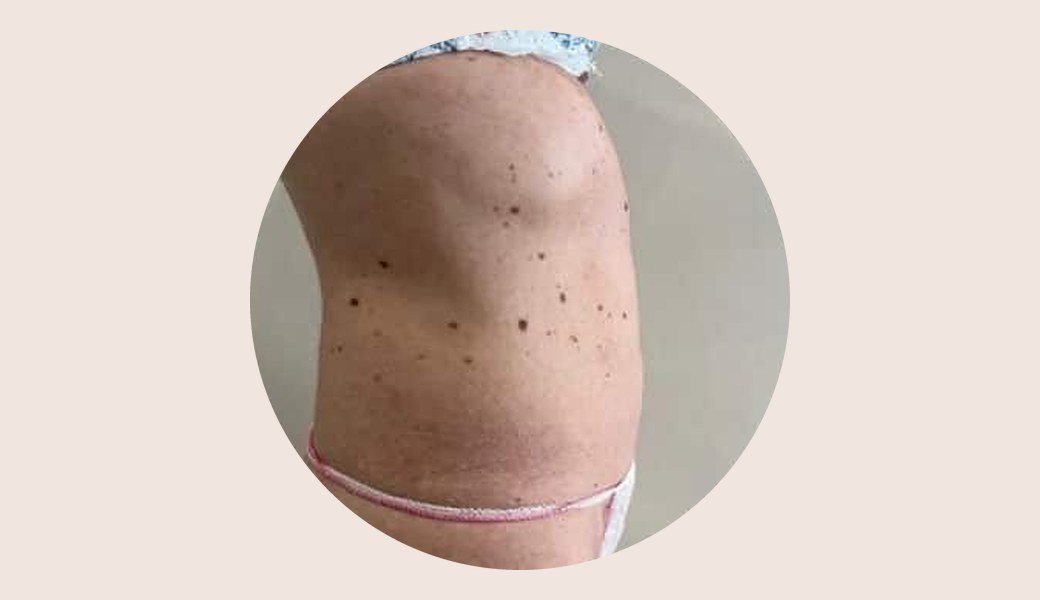 Flancs et ventre de profil après 3 séances de cryolipolyse