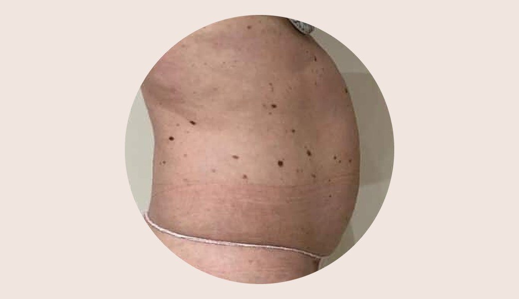 Flancs et ventre de profil avant une cure de cryolipolyse