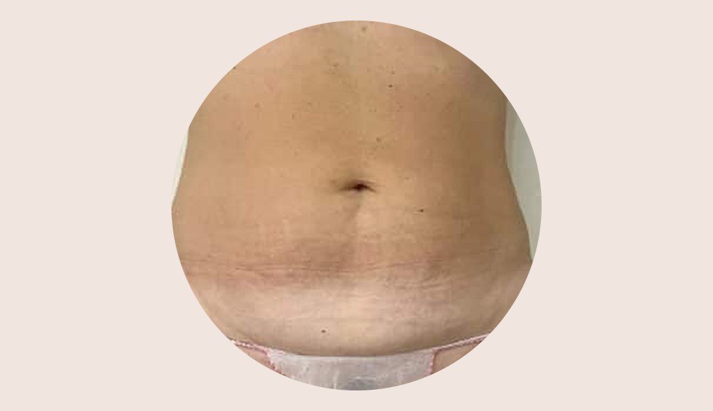 Ventre vu de face après 3 séances de cryolipolyse