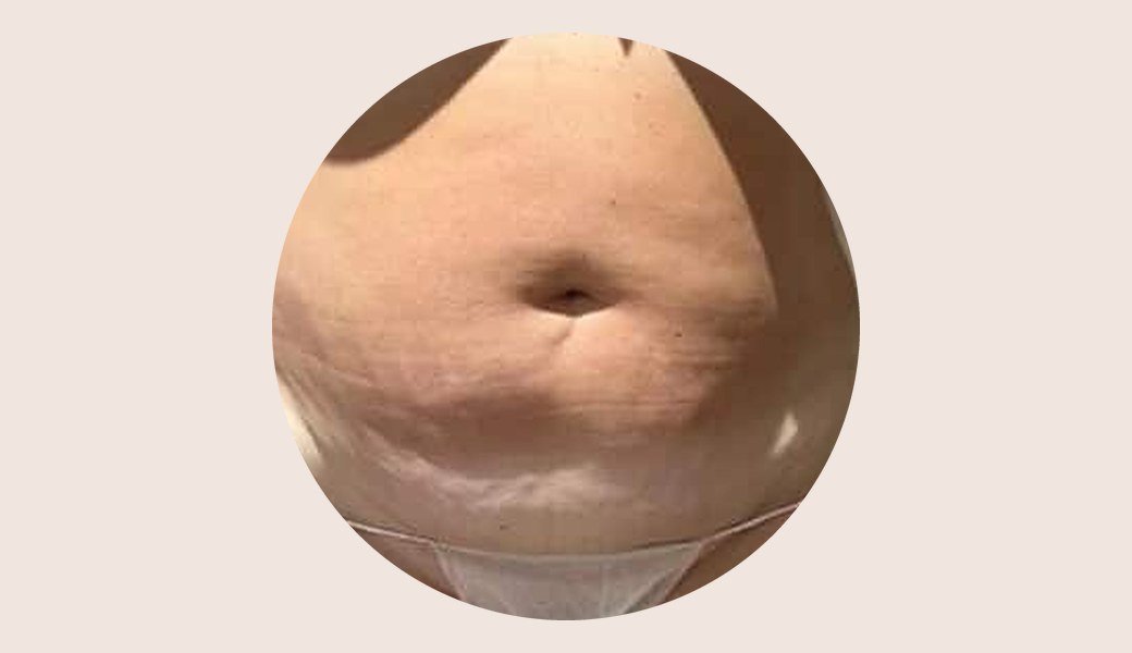 Ventre vu de face avant une cure de cryolipolyse