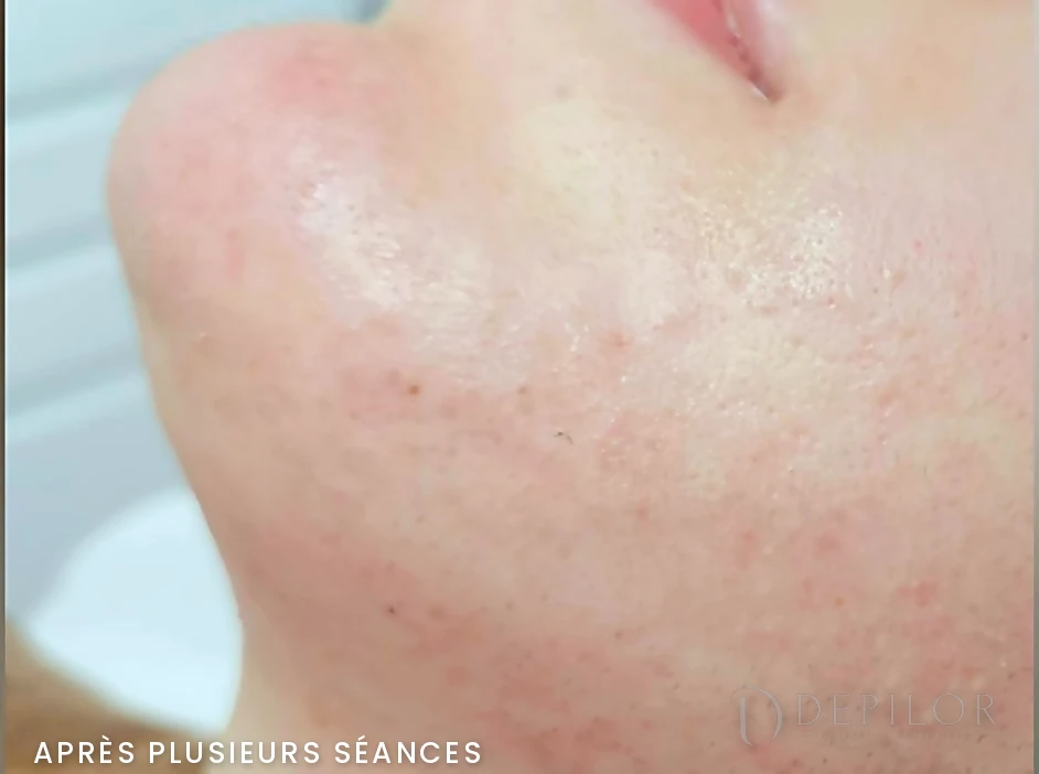 Électrolyse du bas du visage (ovale et cou) chez DEPILOR à Vénissieux, après plusieurs séances : pilosité nettement réduite.