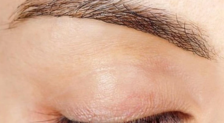 Électrolyse des sourcils chez DEPILOR à Vénissieux, après plusieurs séances : sourcil net et redessiné.