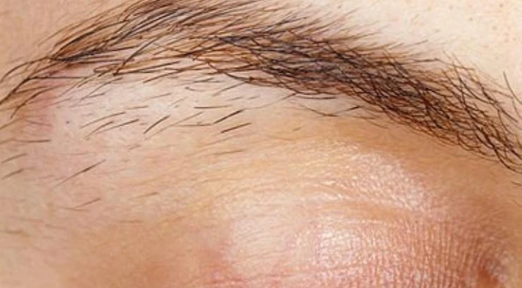 Électrolyse des sourcils chez DEPILOR à Vénissieux, avant : poils épars autour du sourcil.