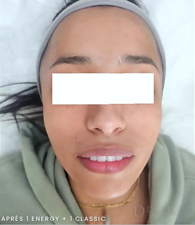 Soin Green Peel du visage chez DEPILOR à Vénissieux, après 1 Energy et 1 Classic : teint unifié et lumineux.