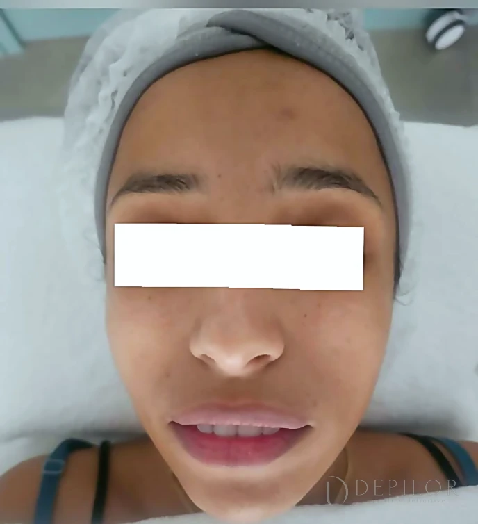 Soin Green Peel du visage chez DEPILOR à Vénissieux, avant le protocole : teint irrégulier.