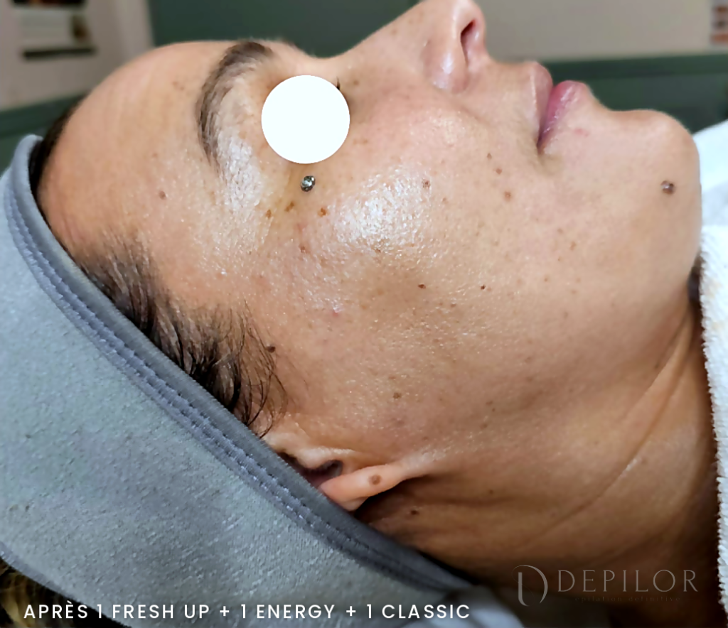 Soin Green Peel du visage (joue) chez DEPILOR à Vénissieux, après le protocole Classic : teint plus homogène, taches estompées.