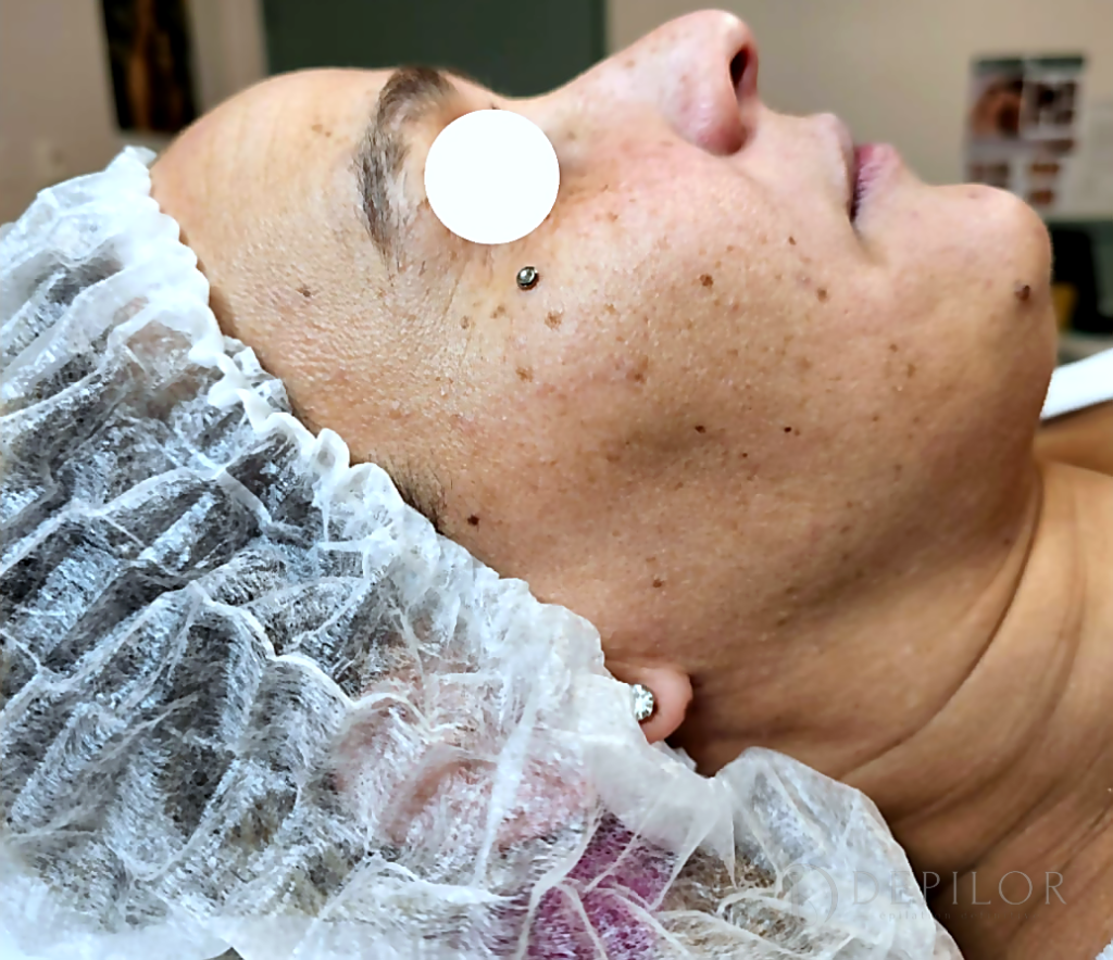 Soin Green Peel du visage (joue) chez DEPILOR à Vénissieux, avant le protocole : taches pigmentaires.