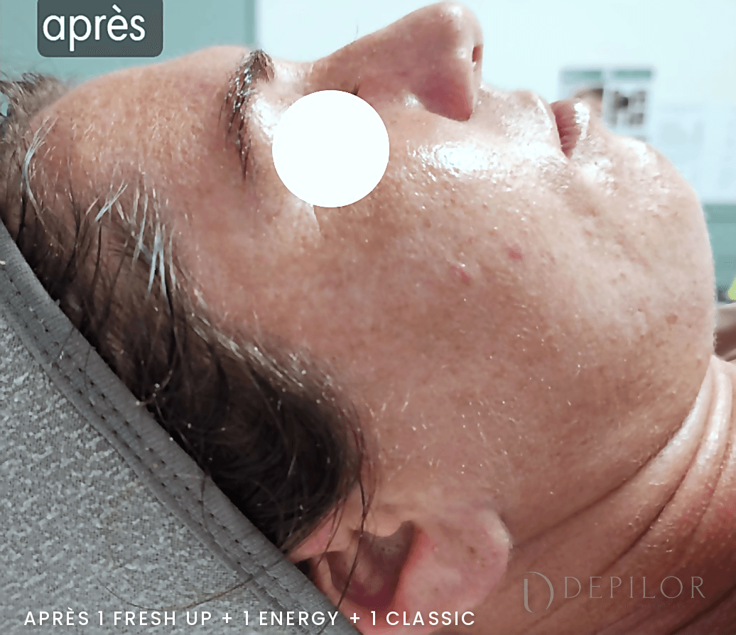 Soin Green Peel du visage (ovale du visage) chez DEPILOR à Vénissieux, après le protocole Classic : peau lissée, teint unifié.