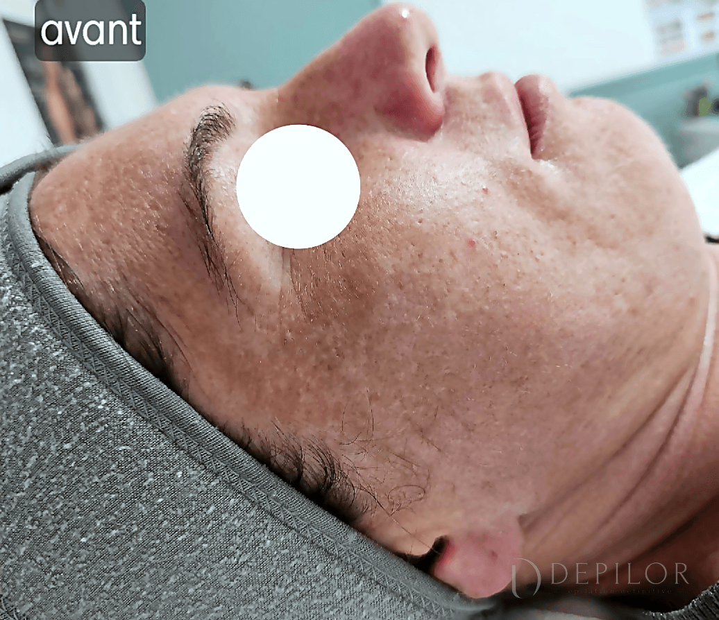 Soin Green Peel du visage (ovale du visage) chez DEPILOR à Vénissieux, avant le protocole : grain irrégulier.