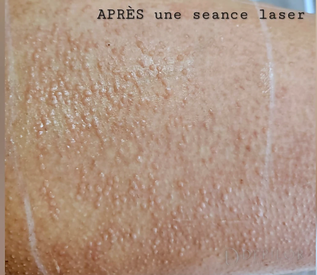Épilation laser de la demi-jambe chez DEPILOR à Vénissieux, après une séance laser : réaction normale de la peau autour des follicules.