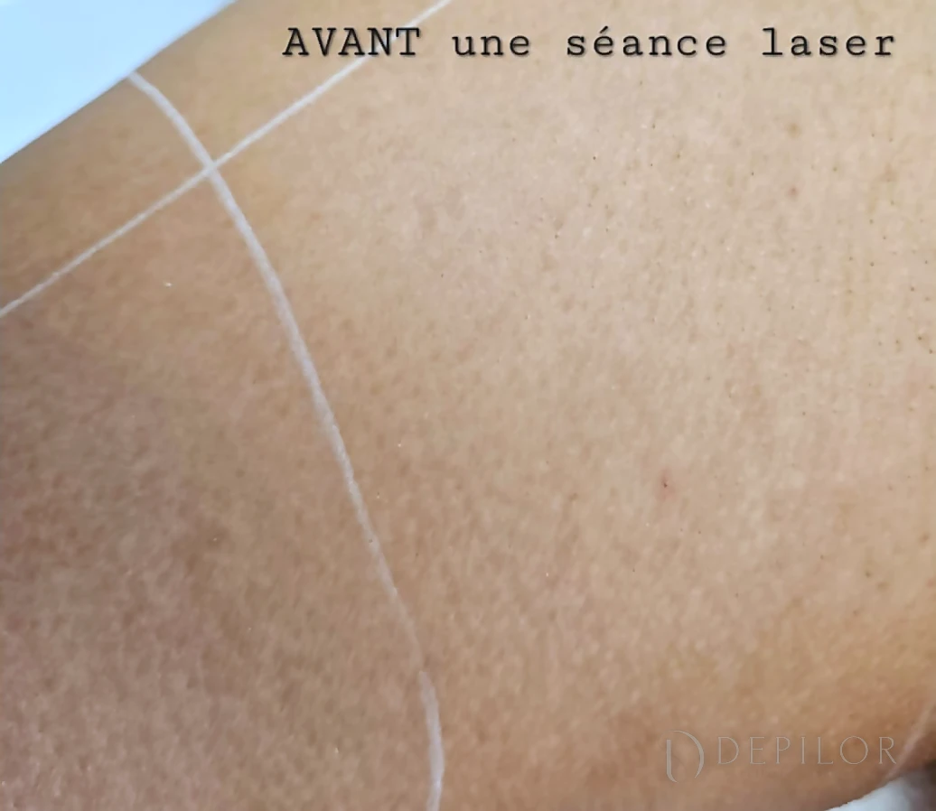 Épilation laser de la demi-jambe chez DEPILOR à Vénissieux, avant une séance laser.