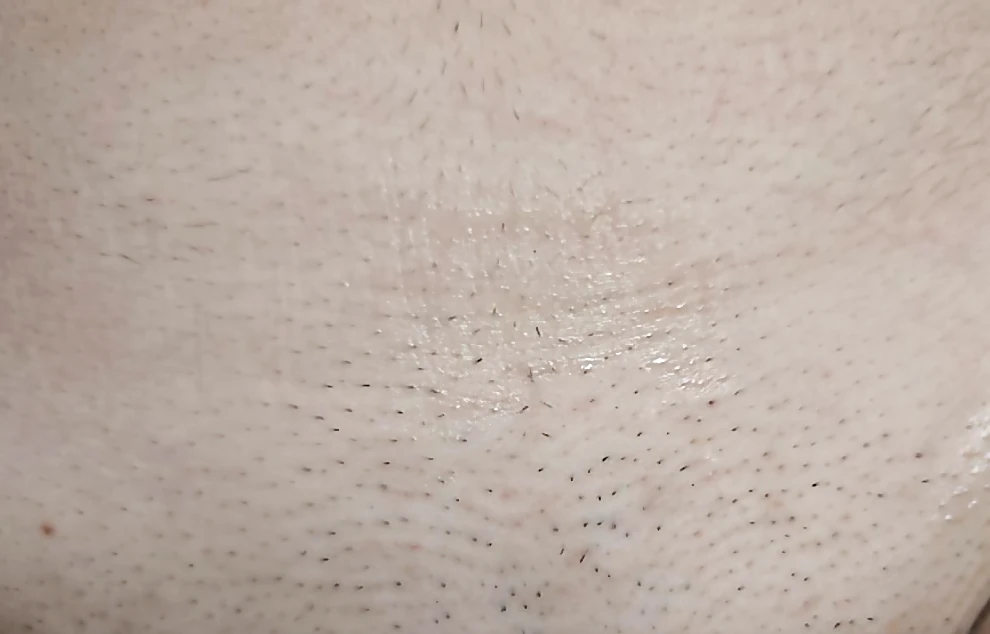 Épilation laser du maillot chez DEPILOR à Vénissieux, après une séance : pilosité réduite.