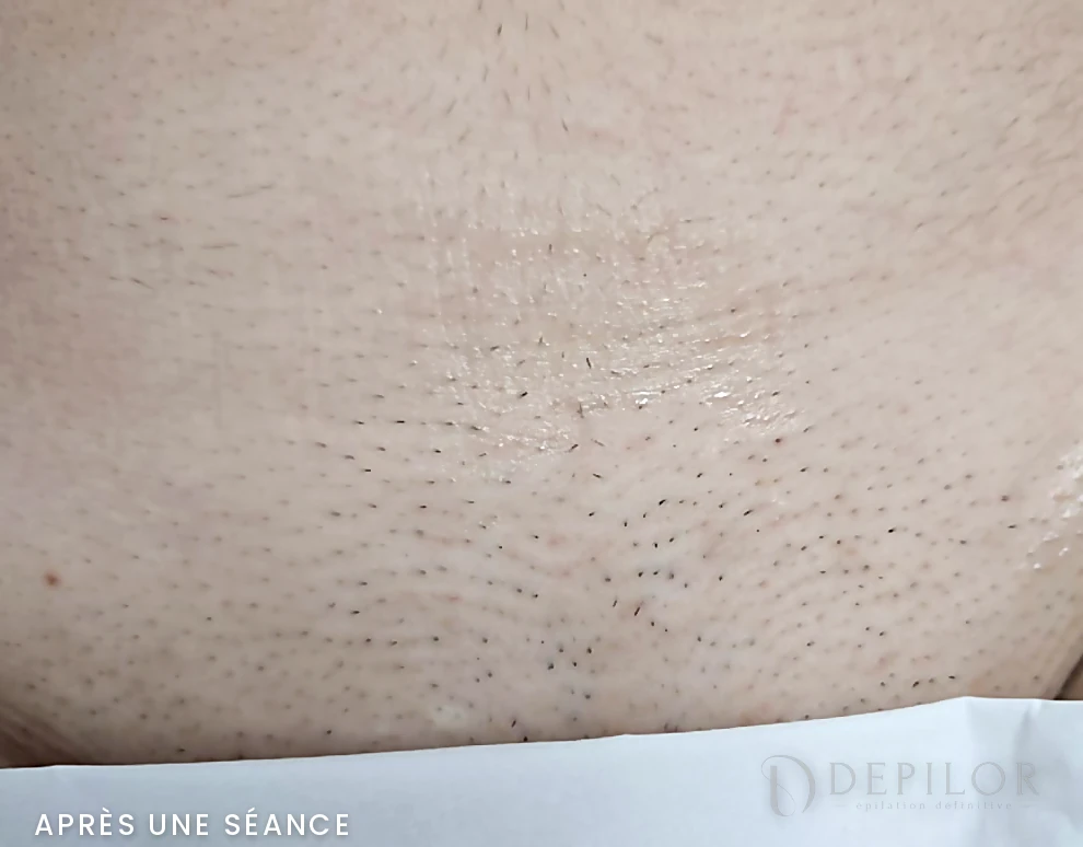 Épilation laser du maillot chez DEPILOR à Vénissieux, après une séance : pilosité réduite.