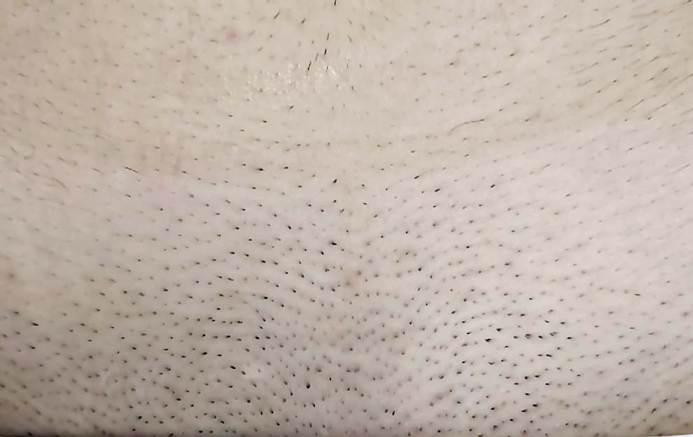 Épilation laser du maillot chez DEPILOR à Vénissieux, avant la séance.