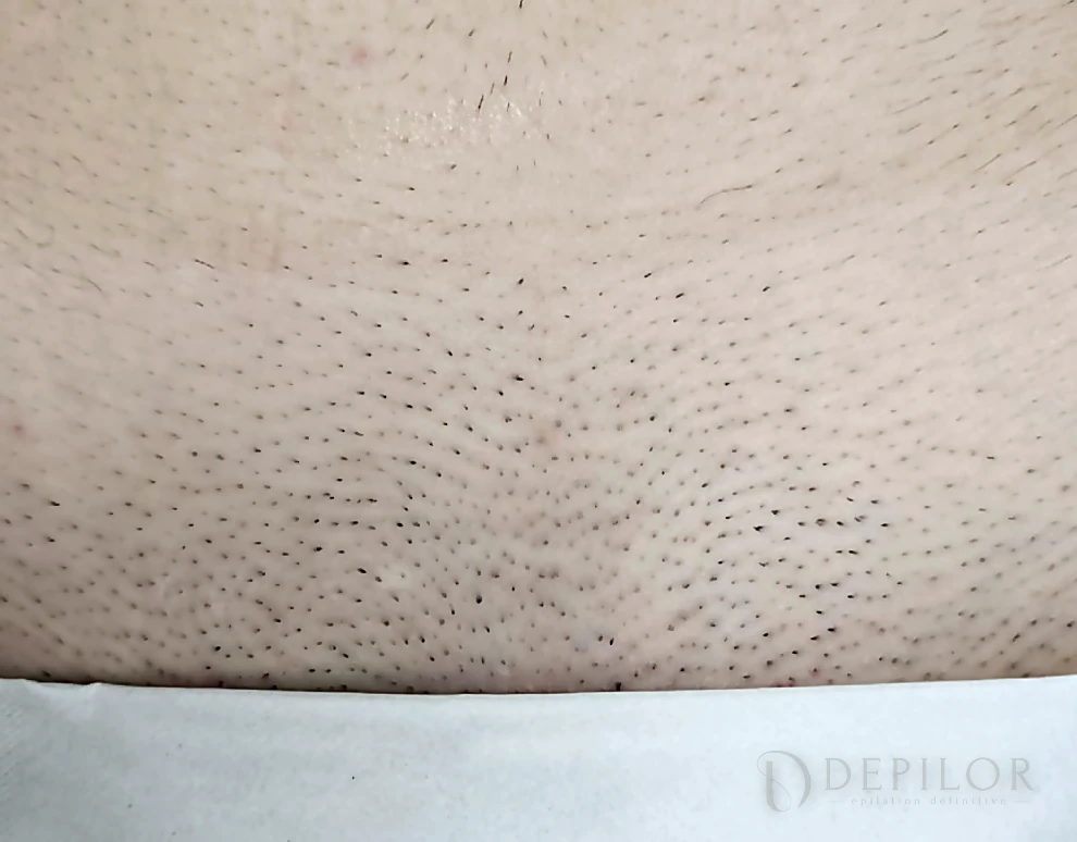 Épilation laser du maillot chez DEPILOR à Vénissieux, avant la séance.