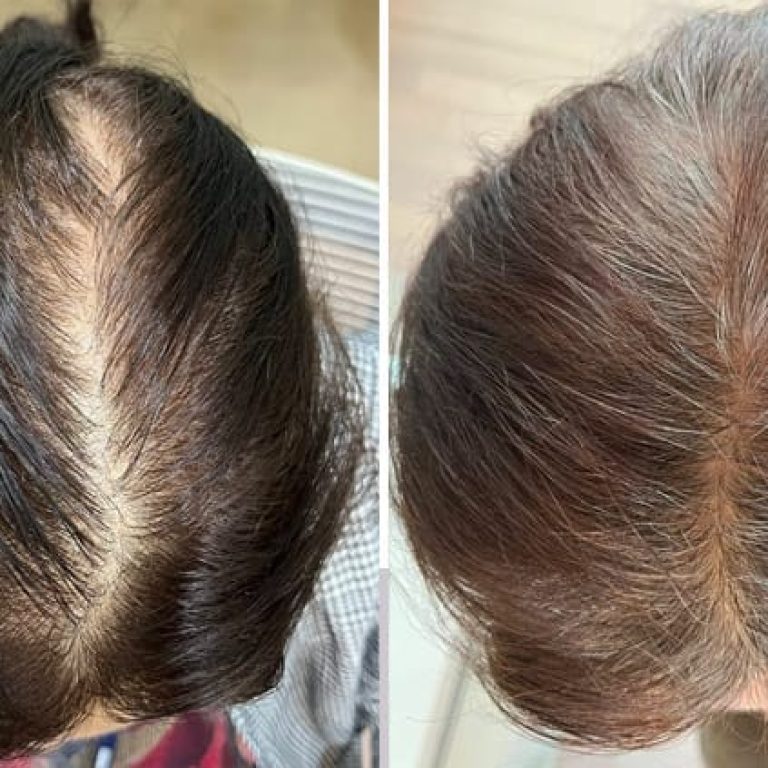 soin chute de cheveux professionnel