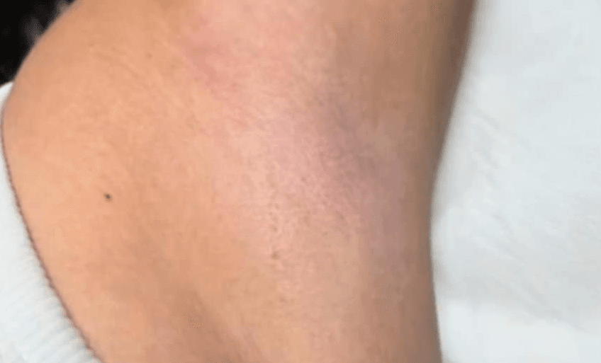 Épilation laser des aisselles chez DEPILOR à Vénissieux, après 6 séances : pilosité fortement réduite.