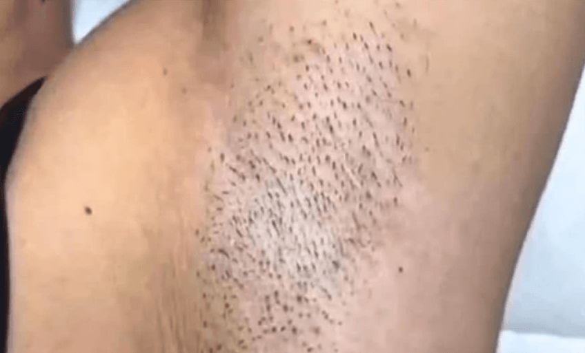 Épilation laser des aisselles chez DEPILOR à Vénissieux, avant les séances.