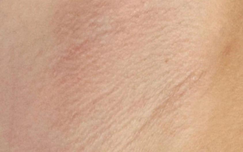 Épilation laser des aisselles chez DEPILOR à Vénissieux, après 7 séances : pilosité fortement réduite.